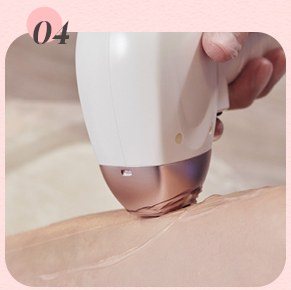 레이저 시술 장비