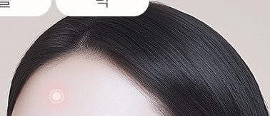 시술 부위가 표시된 여성의 이마 및 얼굴 상단