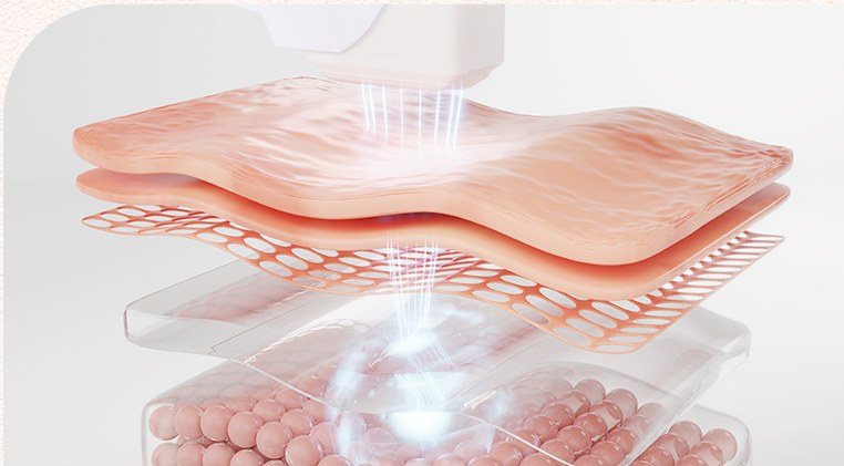 피부 진피층 고주파 열에너지 시술 원리 3D 단면 일러스트