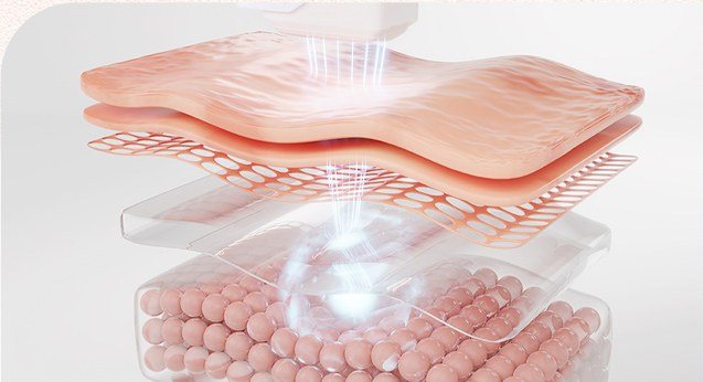 피부 진피층에 고주파 에너지가 조사되는 원리를 나타낸 3D 단면 일러스트