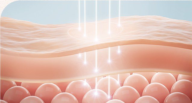 피부 층과 레이저 조사 원리를 나타낸 3D 일러스트