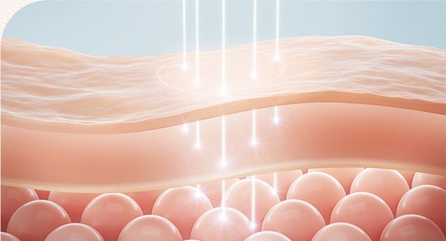 피부 층에 레이저 빛이 침투하는 원리 일러스트