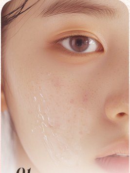 여드름 흉터 피부 부위